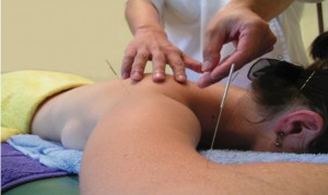 Acupuncture service physio balance 2